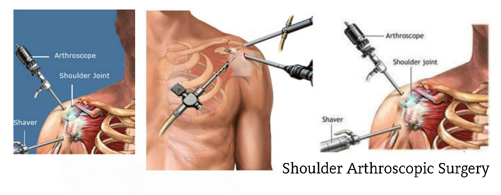 shoulder-arthroscopy